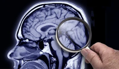 İngiltere Alzheimer hastalığını erken teşhis etmek için kan testleri yapıyor